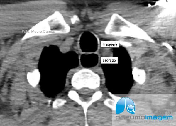 MEGAESÔFAGO CHAGÁSICO MEGAESÔFAGO CHAGÁSICO