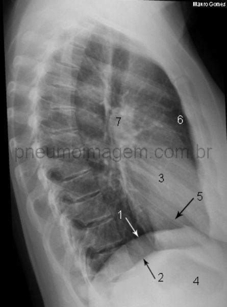 Radiografia De Torax Lateral Normal Masculina