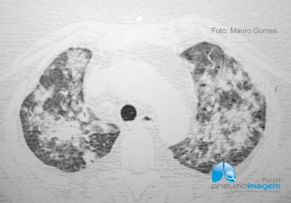 PNEUMONIA POR CITOMEGALOVÍRUS PNEUMONIA POR CITOMEGALOVÍRUS